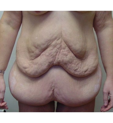 loose skin after weight-loss